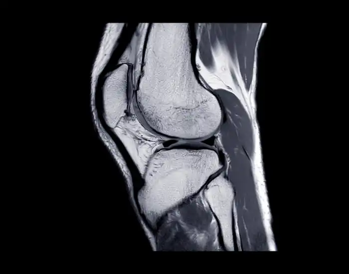 Anterior Knee Pain